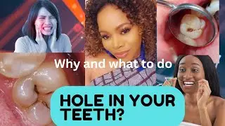 What REALLY Causes Holes in Your Teeth? (Nearly 90% of adults have it) | Ask Dr. Precious