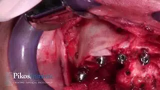 Preview Fully Guided Full Arch Immediate Implant Reconstruction Case with nSequence Prosthetic Proto