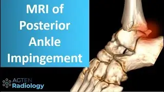 Posterior ankle impingement on MRI