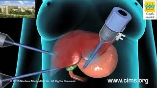 Cholecystectomy Gallbladder Removal  (Gujarati) - CIMS Hospital