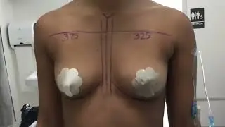 Breast Implant Surgery- Going From an A to a C!