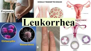 leukorrhea