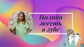 Я в шоке от того что нашли в моем зубе