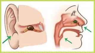Ini Yang Menyebabkan Gangguan Pada Hidung dan Telinga ? Begini Penjelasan Dokter Seputar THT