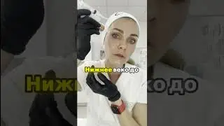 Дермапен Дома часть 9 Как вернуть инвазивность с помощью нажатия кнопки