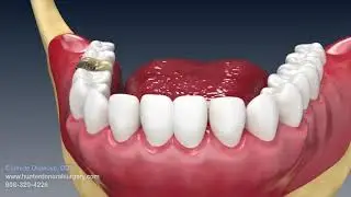 Extraction and socket graft animation