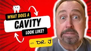 What Does a Cavity Look Like? | Learn the Basics From a Pediatric Dentist