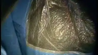 Constrictive pericarditis