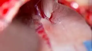 Dr. Takanori Fukushima - Epidermoid Brain tumour - Delicot Ultra-Thin Neurosurgical Pattie