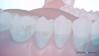 Tooth scaling and root planning animation