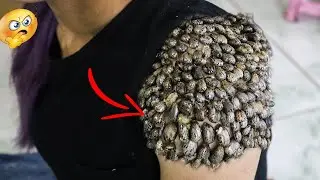Oh god ! Look How to Remove Giant Ticks #298