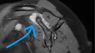 Solving a Shoulder MRI