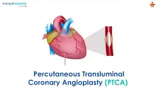 What is Percutaneous Transluminal Coronary Angioplasty (PTCA)? l Manipal Hospitals Bengaluru