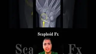 Scaphoid Fracture - 