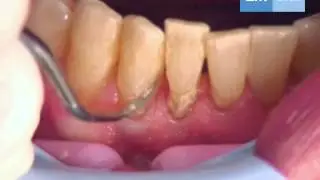 Clinical use of: Mini Sickle