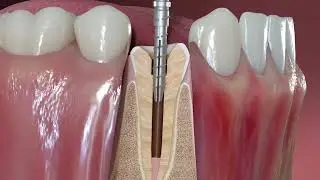 Flexi-Post inserted into the root canal space