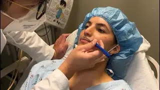 SURGERY | Recreating The Cupids Bow and Central Columns