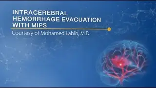 Intracerebral Hemorrhage Evacuation with MIPS, Mohamed Labib MD