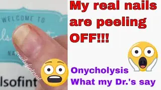 My Nails Are Falling Off!! 😱😱😱 Onycholysis What My Doctor Told Me To Do.