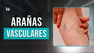 Elimina Varices y Arañas Vasculares Eficazmente: Guía Completa | Clínicas Be
