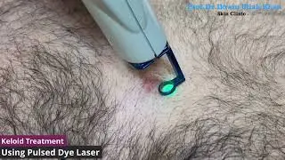 Keloid Scars No More! Saying Goodbye with Pulsed Dye Laser Treatment #lasertreatment #keloids