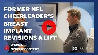 Breast Implant Revision & Lift: Former NFL Cheerleader's Transformation