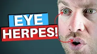 Cold Sores On Eyes! - Eye Herpes Explained (HSV)