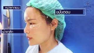 รีวิวฉีดไขมัน