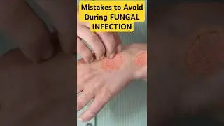 बार बार Fungal Infections क्यूँ होता है? 