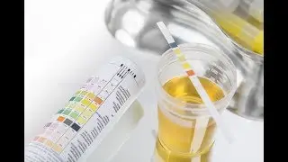 4 Reasons Why Your Urine is Dark in Color