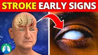 Before a Stroke | Never Ignore These Early Warning Signs