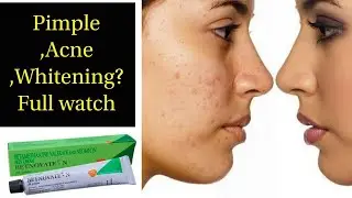 Betnovate N Cream |Best Acne Treatment |  oily skin | pimple clear | supriyatheclassytips
