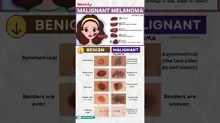 How to Identify Melanoma | Skin Cancer Early Signs