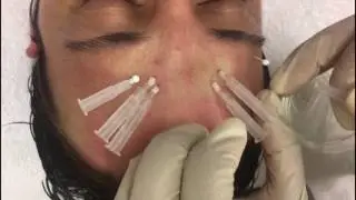 Threads for lifting and lines on the face