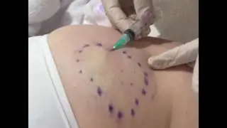 Subcision for cellulite and dimpling