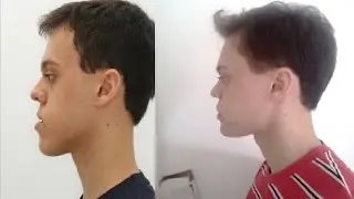 Antes e Depois - Minha Cirurgia Ortognática