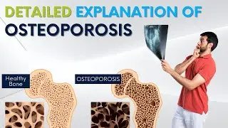 Know Everything About Osteoporosis Dr. Kunal Shah