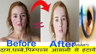Pimples clean in photoshop (दाग,धब्बे,पिम्पल्स आसानी से हटायें)