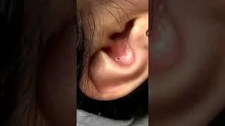 Black head removal on face - Blackheads on back treatment