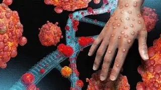 MONKEY/MPOX CAUSES, PREVENTION AND MANAGEMENT | DID YOU KNOW COMMERCIAL SEX WORKERS SPREAD IT (SEX)