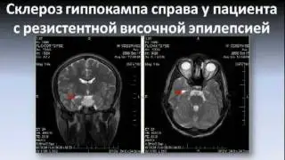 Провокаторы приступов. Часть 1.