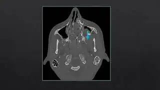 Chirurgie Endoscopique du Fibrome Nasopharyngé