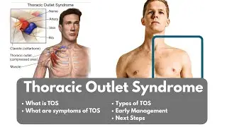 What is Thoracic Outlet Syndrome | Symptoms, Types of TOS, and Early Management