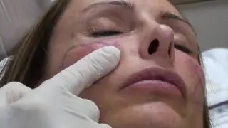 Dermal Fillers in Chevy Chase, MD | Philip Schoenfeld MD, FACS