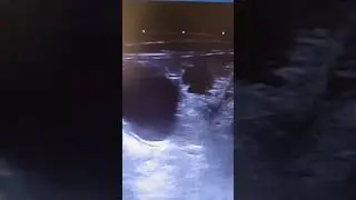 Анэхогенные полости в печени