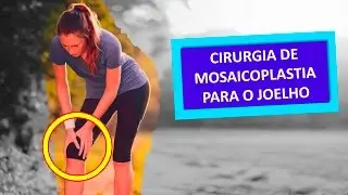 CIRURGIA DE MOSAICOPLASTIA PARA O JOELHO