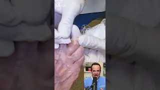 DOCTOR REACTS:INCREDIBLE SIZE CORN ON TOE! UNREAL!😱 #shorts