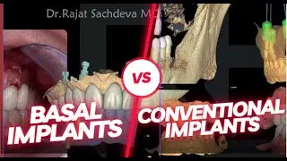 Basal vs Conventional Implants | Deciding Between Basal and Conventional Implants