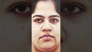 Spreader grafts , extension grafts, alar baton grafts nose job plastic surgery
