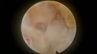 Extraforaminal disc - Full endoscopic discectomy